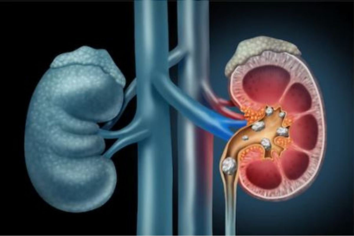 Kidney Stones: ਜਾਣੋ ਕਿਡਨੀ ਸਟੋਨ ਦੇ ਲੱਛਣ ਅਤੇ ਬਚਾਅ, ਨੌਜਵਾਨਾਂ 'ਚ ਵੱਧ ਰਿਹਾ ਇਸਦਾ ਖਤਰਾ 
