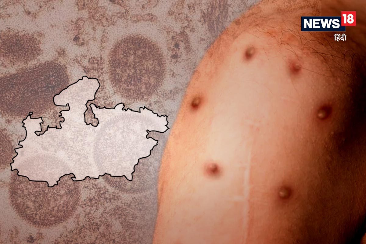 ਮੱਧ ਪ੍ਰਦੇਸ਼ 'ਚ Monkeypox ਨੂੰ ਲੈ ਕੇ ਅਲਰਟ ਜਾਰੀ