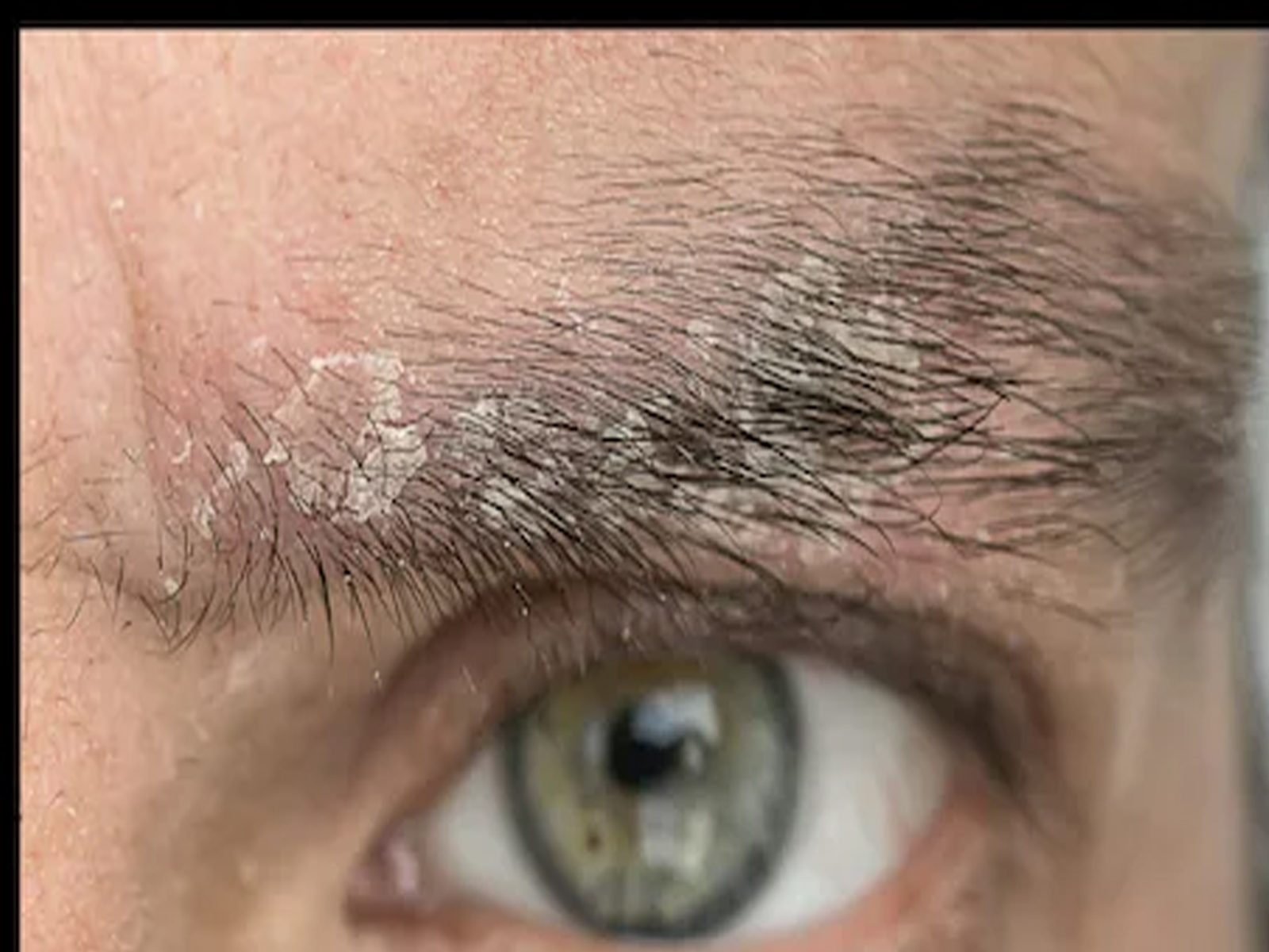 Eyebrow Dandruff: ਆਈਬ੍ਰੋ ਉੱਤੇ ਵੀ ਆਉਂਦਾ ਹੈ ਡੈਂਡਰਫ? ਕੀ ਇਹ ਕਿਸੀ ਬਿਮਾਰੀ ਦਾ ਸੰਕੇਤ ਤਾਂ ਨਹੀਂ
