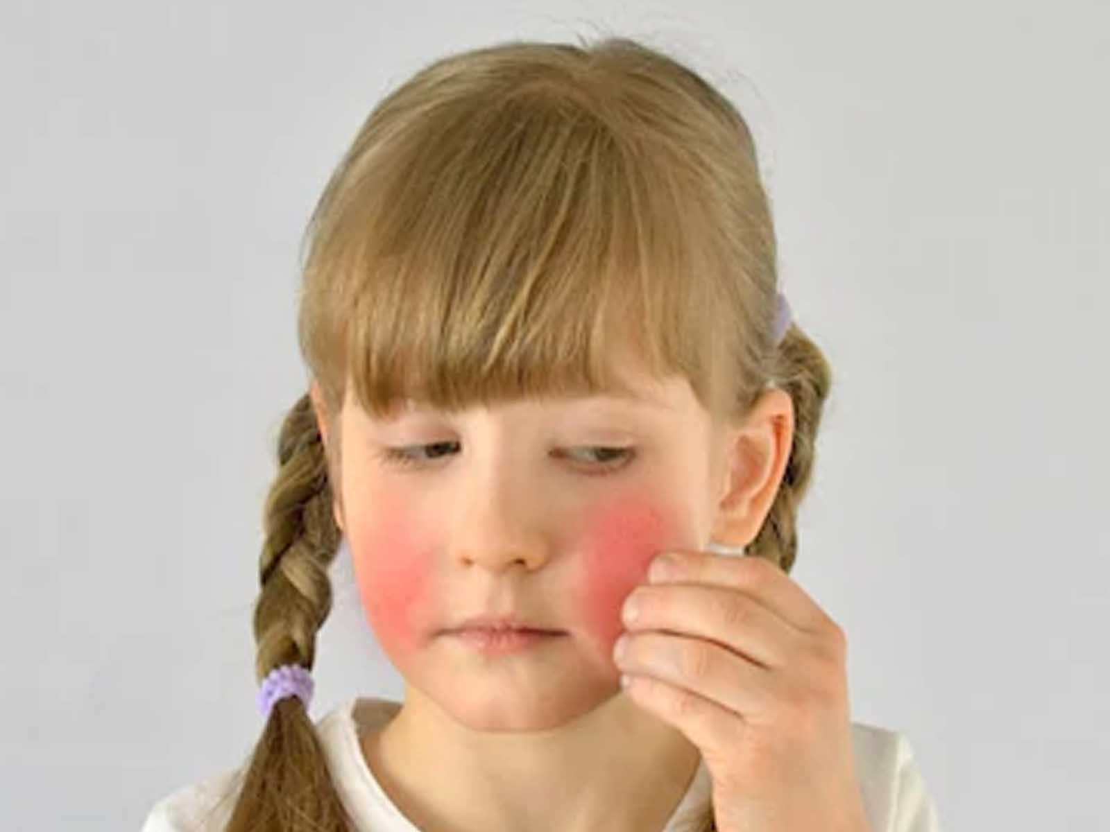 Allergy in kids: ਬੱਚੇ ਨੂੰ ਇਨ੍ਹਾਂ ਕਾਰਨਾਂ ਕਰਕੇ ਵੀ ਹੋ ਸਕਦੀ ਹੈ ਐਲਰਜੀ, ਜਾਣੋ ਘਰੇਲੂ ਇਲਾਜ 